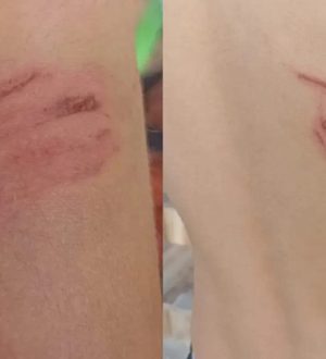 Hilvan’da Sokak Köpeği Saldırısı: Küçük Enes Yaralandı, Mahalleli Tepkili