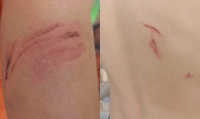  Hilvan’da Sokak Köpeği Saldırısı: Küçük Enes Yaralandı, Mahalleli Tepkili
