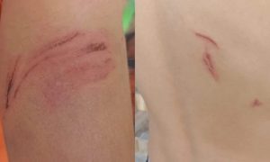 Hilvan’da Sokak Köpeği Saldırısı: Küçük Enes Yaralandı, Mahalleli Tepkili